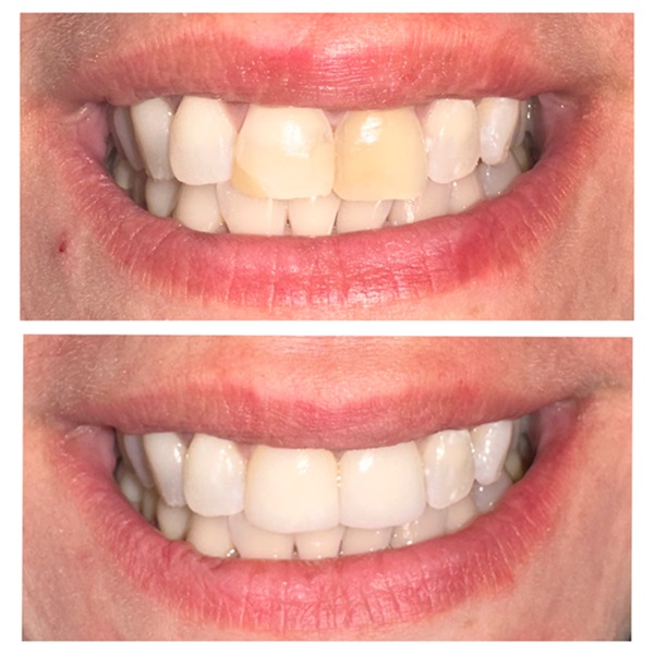 Esthetic Crowns - Before and After